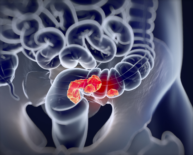 colorectal cancer statistics